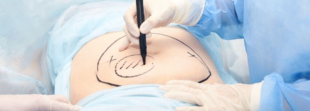 Cosmetic surgeon marks a patient for a body sculpting procedure which removes fat cells but won't result in much weight loss 